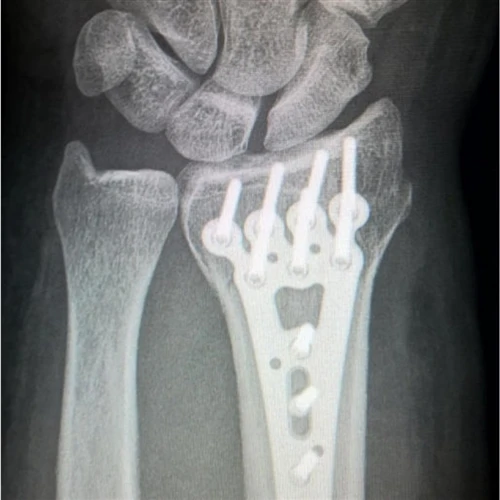 Titanium Alloys: Why Can They “Grow” Into Bone And Still Allow You To Undergo...