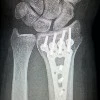 Titanium Alloys: Why Can They “Grow” Into Bone And Still Allow You To Undergo...